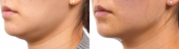 Lifted jawline result